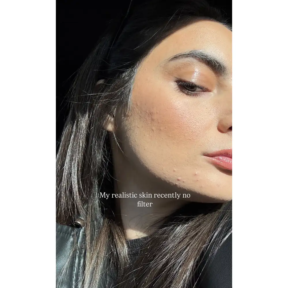 Paige DeSorbo Gives Realistic Look at Her Acne