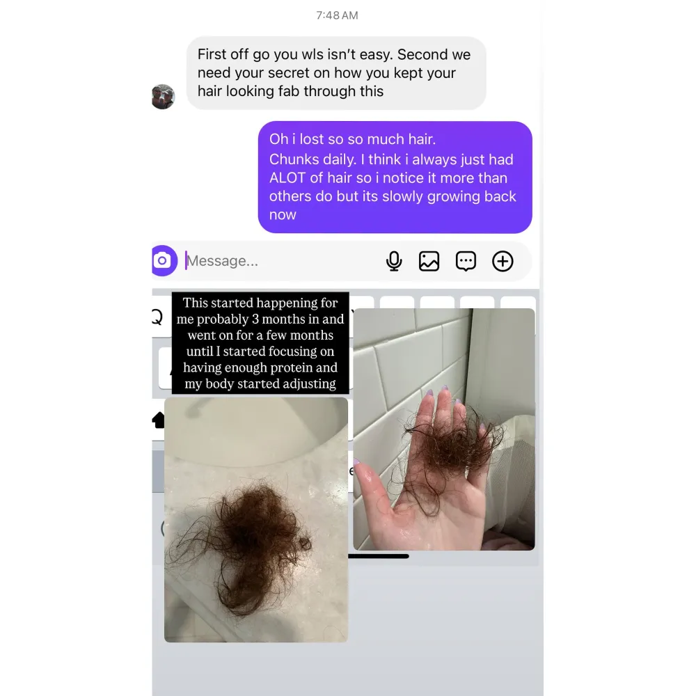 Remi Bader Lost So Much Hair While Recovering From Her Weight Loss Surgery