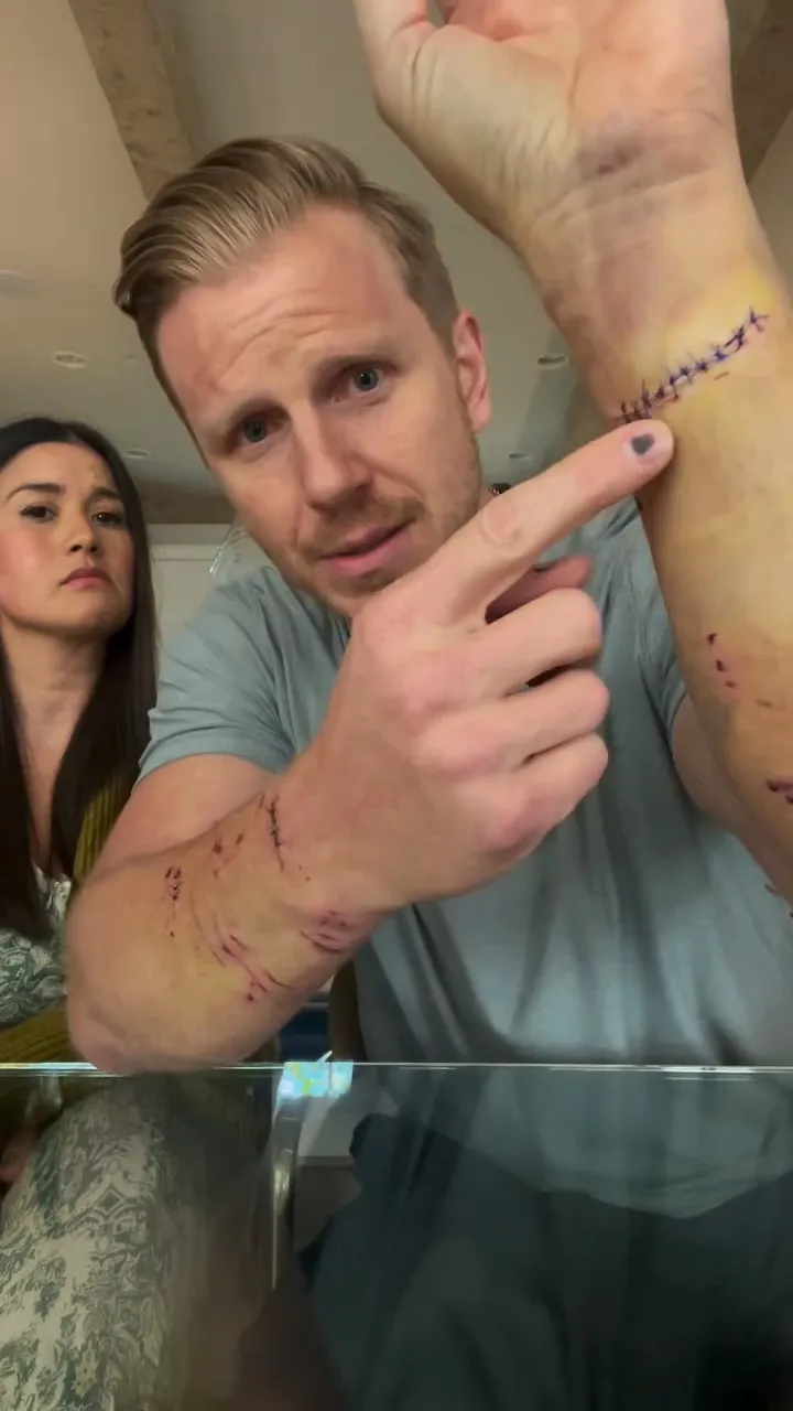 Sean Lowe Shows Off Gnarly Injuries After Getting Attacked by Family Dog Twice in 12 Hours 366