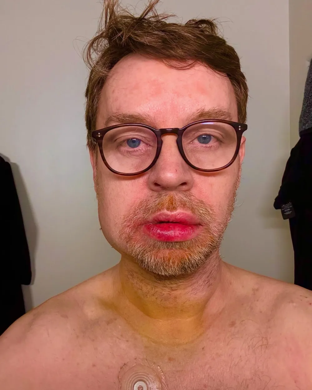 Savage Garden Star Darren Hayes Reveals He Snapped His Jaw in Half After Fainting