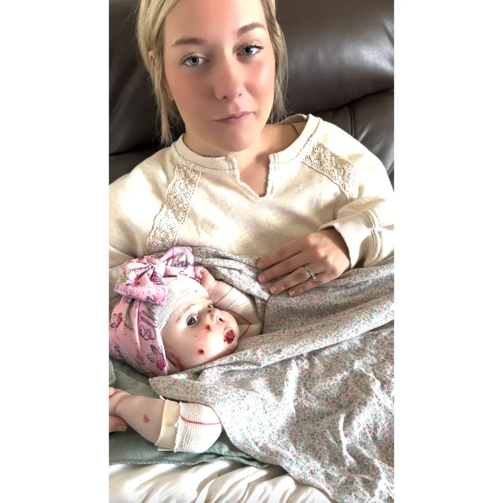 What is Epidermolysis Bullosa Explainer