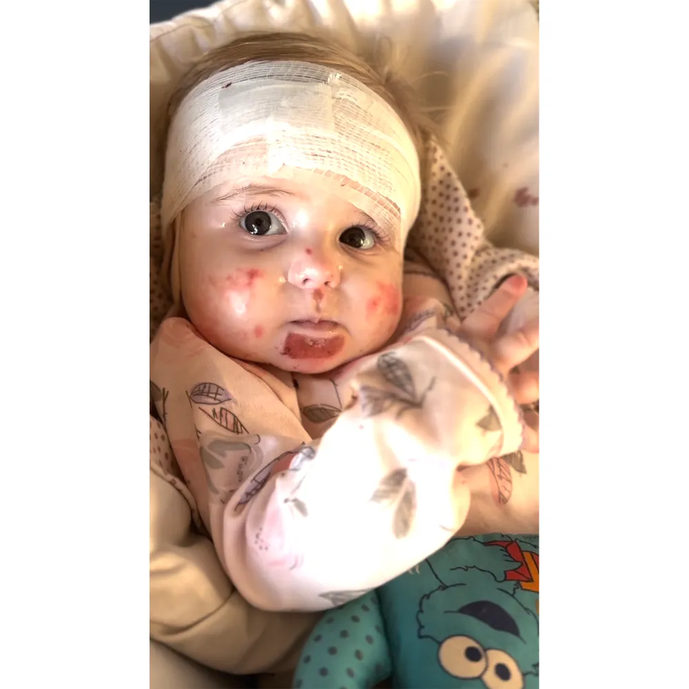 What is Epidermolysis Bullosa Explainer