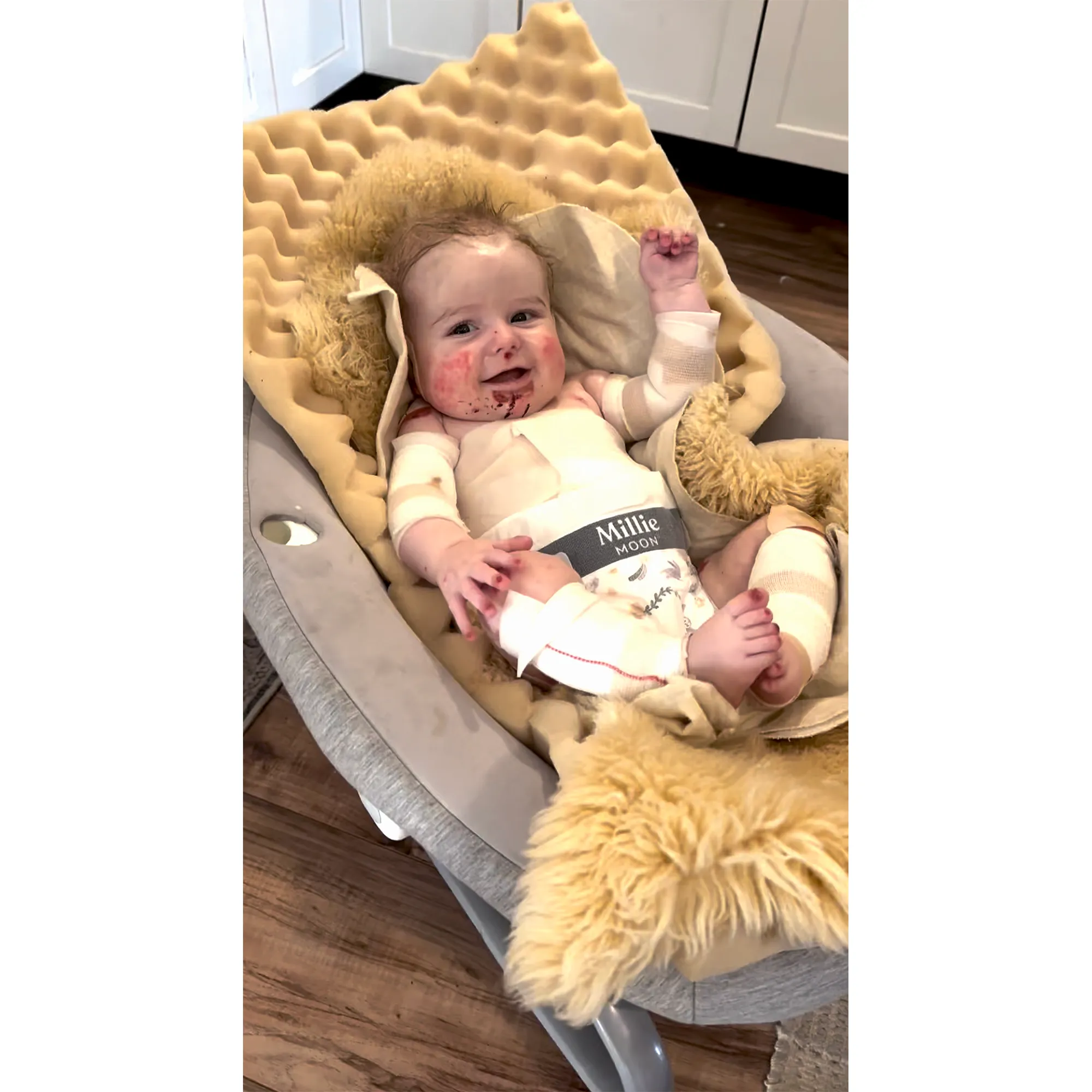 What is Epidermolysis Bullosa Explainer