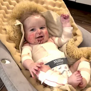 What is Epidermolysis Bullosa Explainer