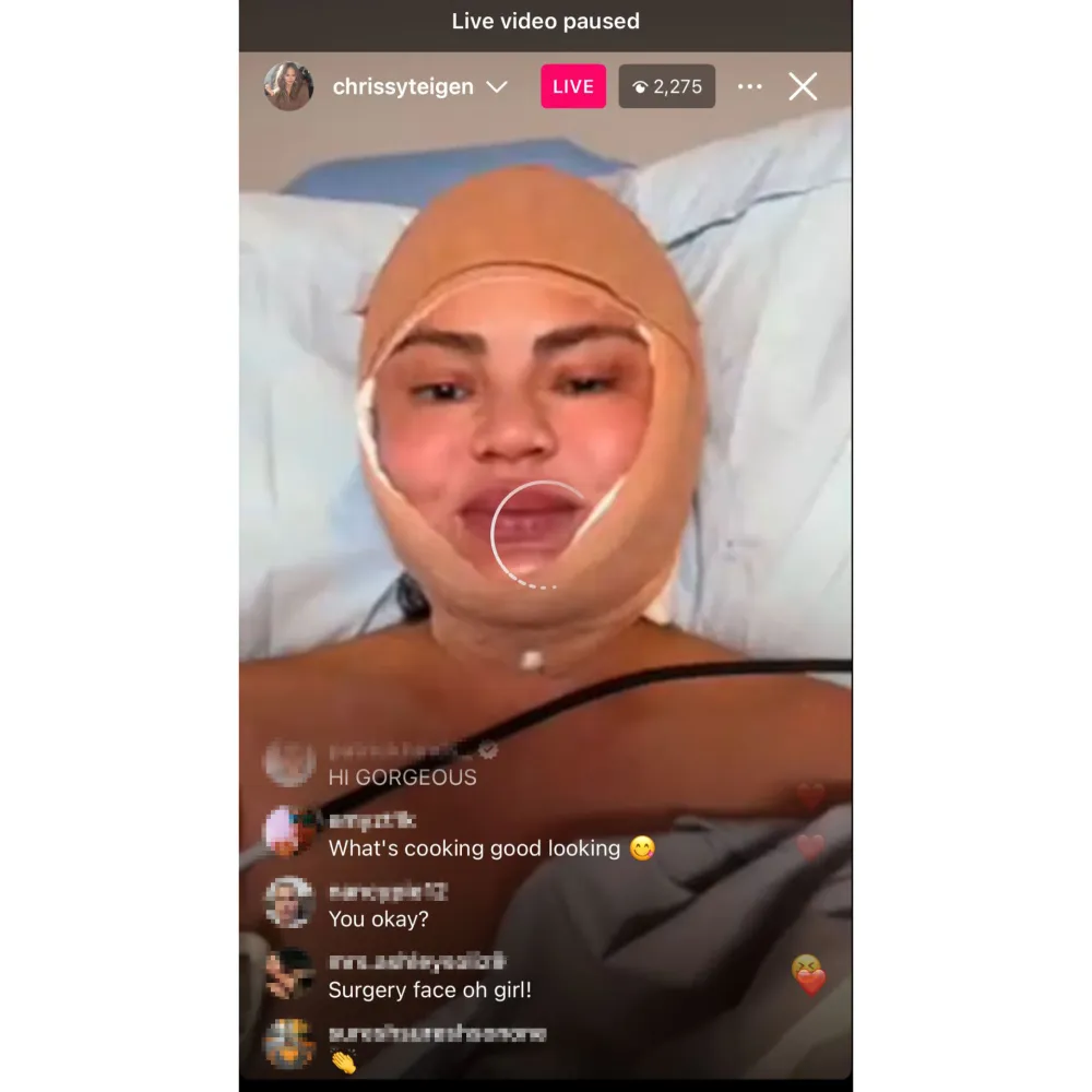 Chrissy Teigen Shows Her Bandaged Face on Instagram Live 2