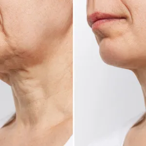 Lower part of the face and neck of elderly woman with signs of skin aging before and after facelift, plastic surgery on white background. Age-related changes, flabby sagging skin, wrinkles, creases