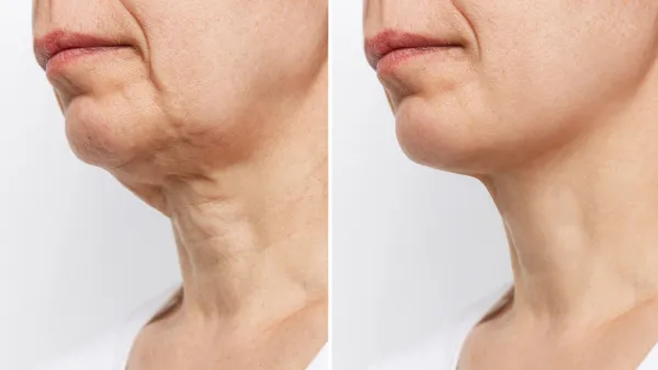 Lower part of the face and neck of elderly woman with signs of skin aging before and after facelift, plastic surgery on white background. Age-related changes, flabby sagging skin, wrinkles, creases