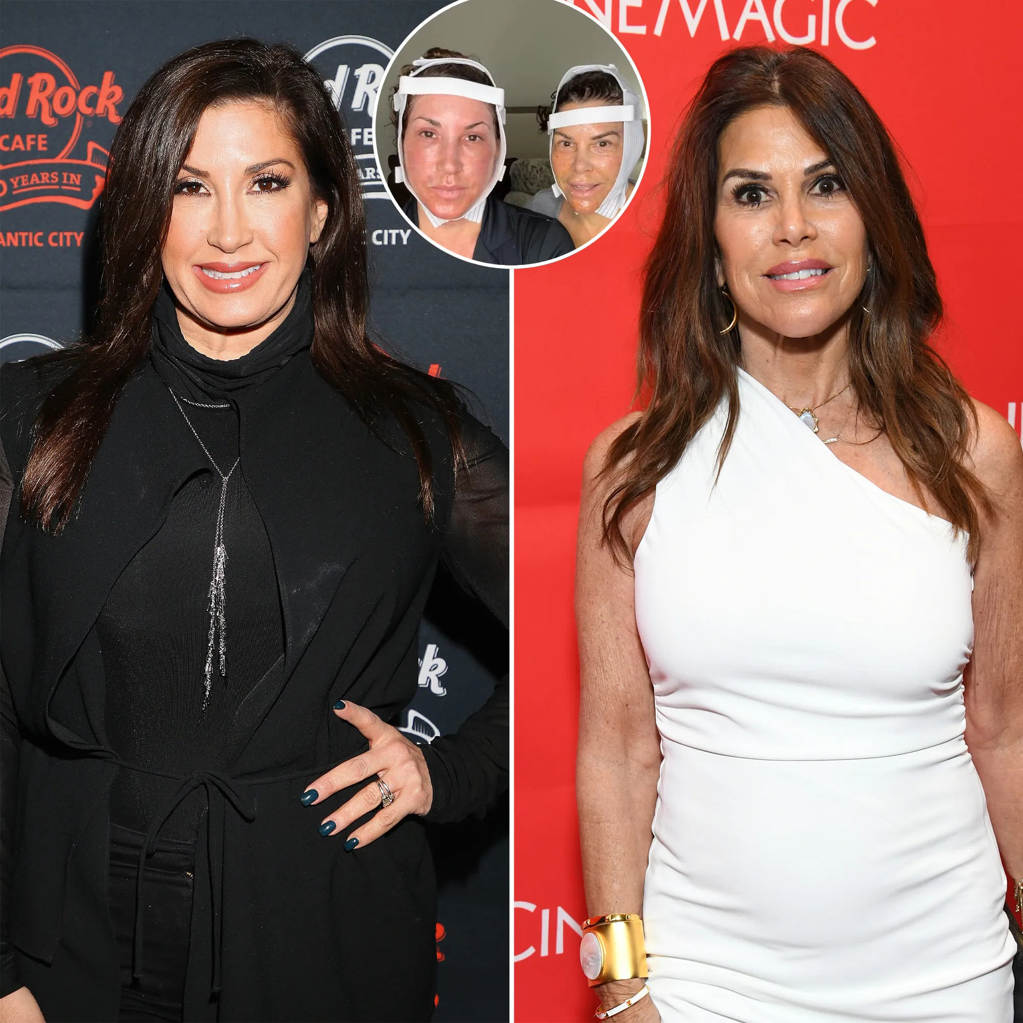 Real Housewives Jacqueline Laurita and Lynne Curtin Document Their Face Lifts Together