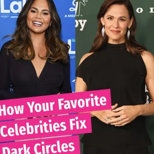 Celebrities with dark circles