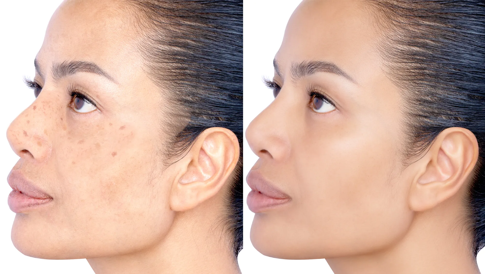 Before and after Healing and removing spot melasma pigmentation facial treatment. Problem of facial skin on middle age beauty Asia woman skin Cosmetology therapy concept. Headshot isolated on white.