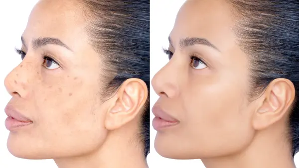 Before and after Healing and removing spot melasma pigmentation facial treatment. Problem of facial skin on middle age beauty Asia woman skin Cosmetology therapy concept. Headshot isolated on white.