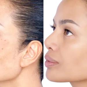 Before and after Healing and removing spot melasma pigmentation facial treatment. Problem of facial skin on middle age beauty Asia woman skin Cosmetology therapy concept. Headshot isolated on white.