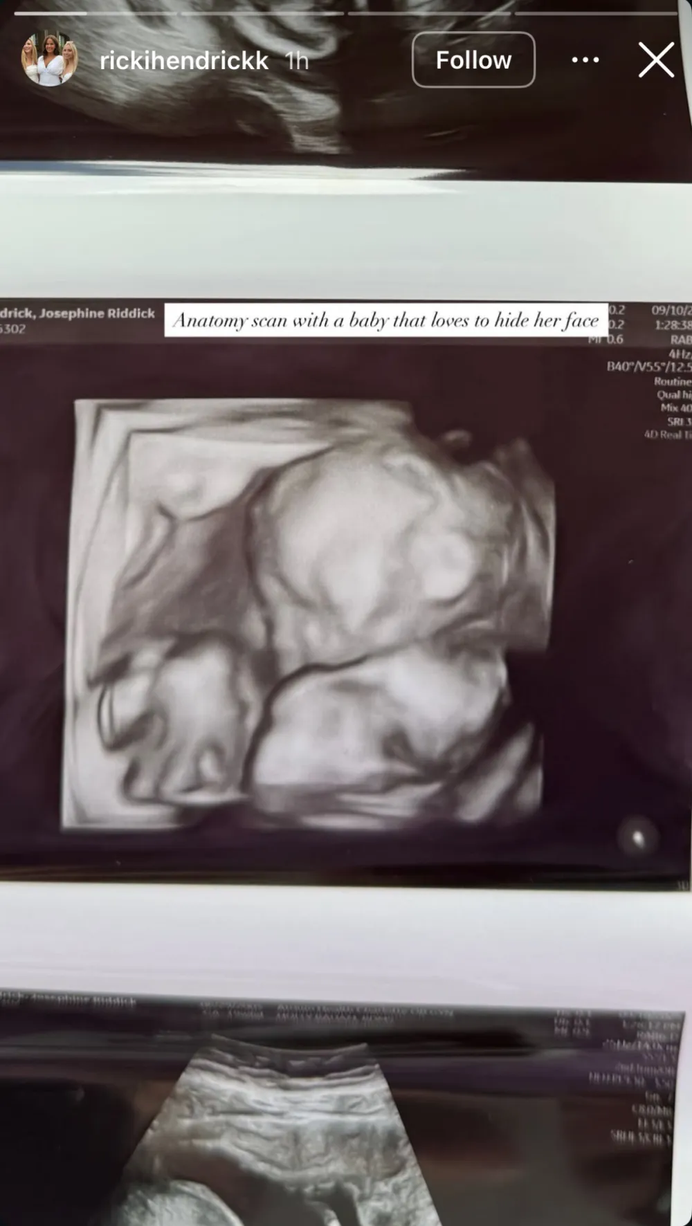 Emily Maynards Pregnant Daughter Ricki Shares Sonogram of Her Baby Girl Perfect Gift