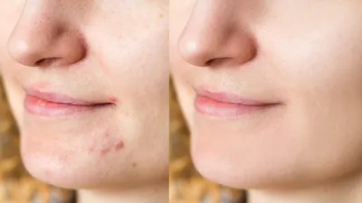 Comparison portrait of young beautiful woman before and after skin treatment