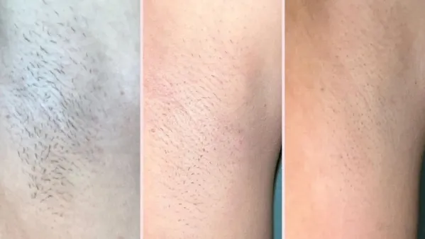 RoseSkinCo. Lumi Permanent Hair Removal Device