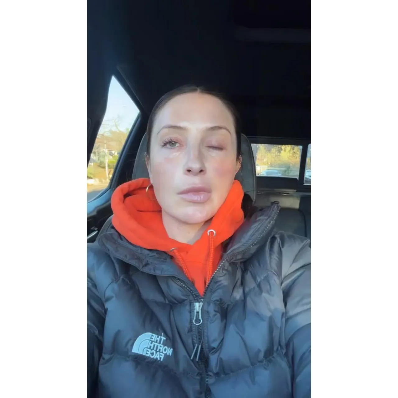 Bristol Palin Gives Update on Health 1 Year After Face Paralysis