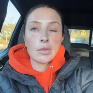 Bristol Palin Gives Update on Health 1 Year After Face Paralysis