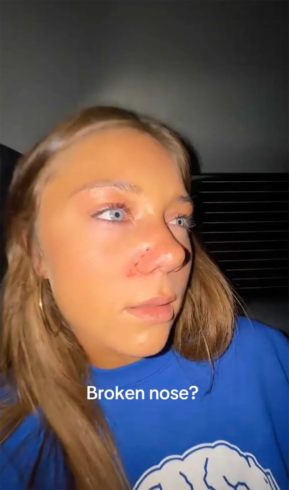 DWTS Troupe Dancer Hailey Bills Reveals Possible Broken Nose After Thanksgiving Game Gone Wrong