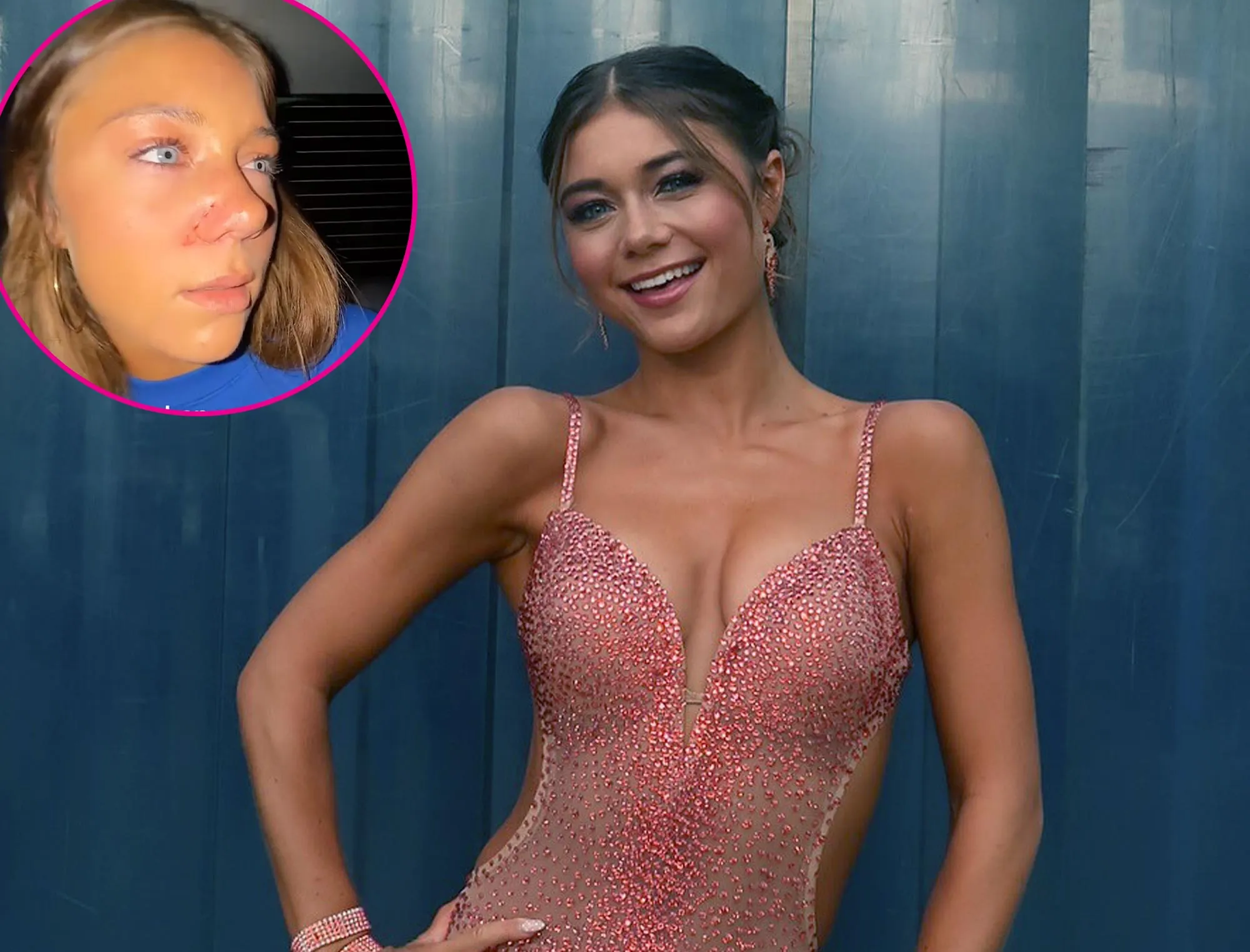 DWTS Troupe Dancer Hailey Bills Reveals Possible Broken Nose After Thanksgiving Game Gone Wrong