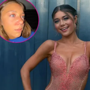 DWTS Troupe Dancer Hailey Bills Reveals Possible Broken Nose After Thanksgiving Game Gone Wrong