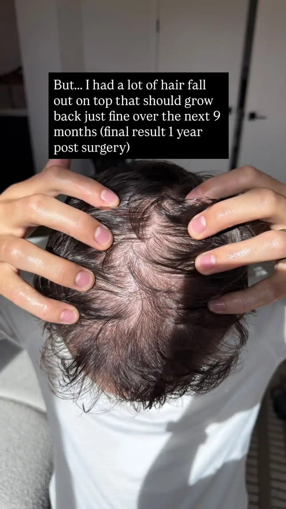 TikTok&rsquo;s Matt Howard Shares Photo Update After Receiving Hair Transplant