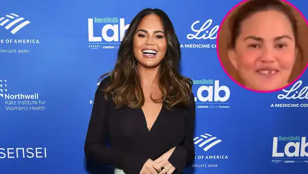 Promo Chrissy Teigen Knocks Out Front Tooth in Candy Cane Accident