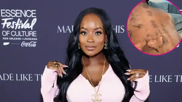 RHOA s Shamea Morton Sues Over Chemical Burn Gone Wrong