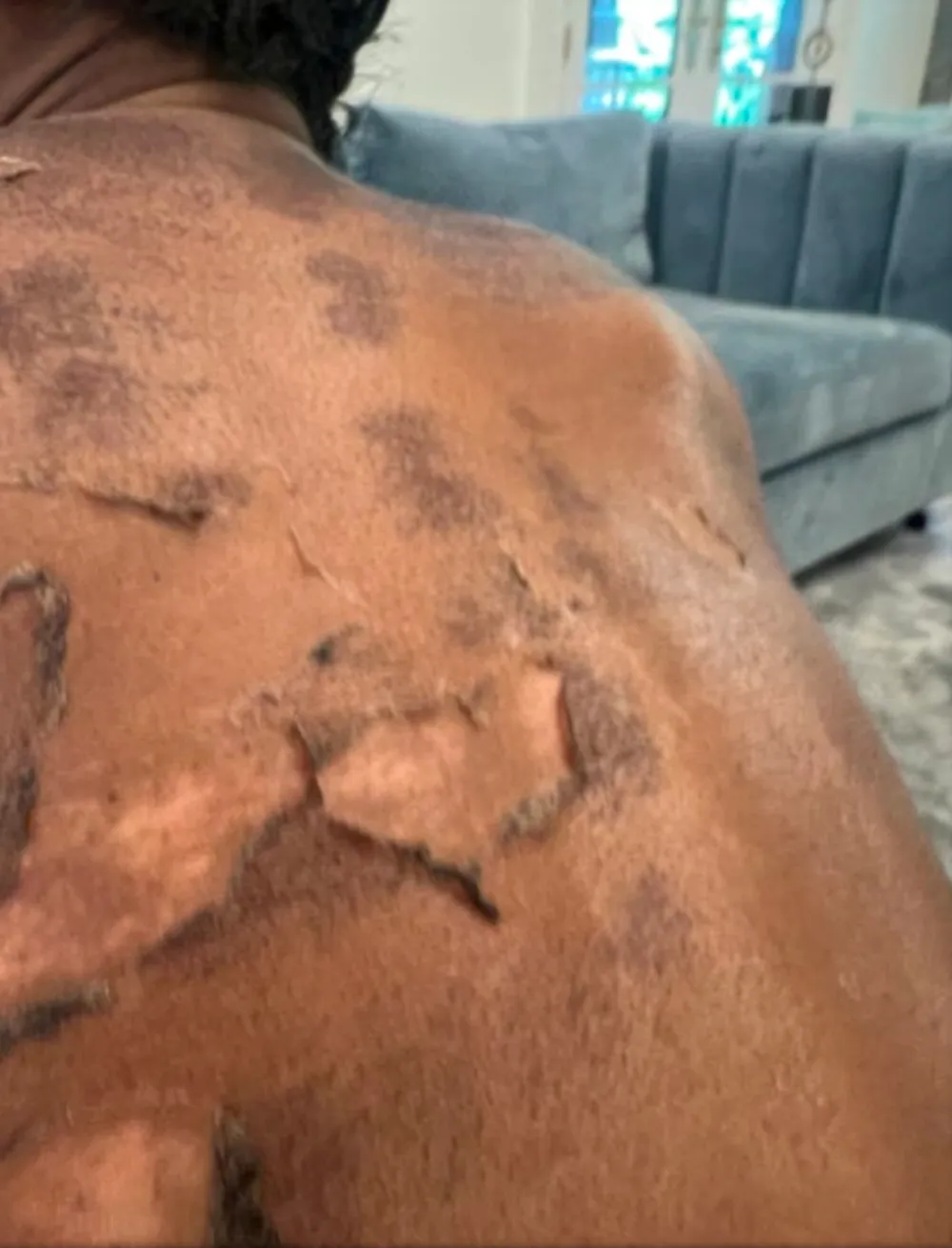 RHOA s Shamea Morton Sues Over Chemical Burn Gone Wrong
