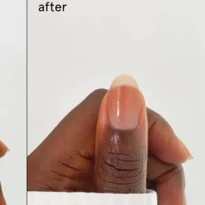Nail Recovery Treatment
