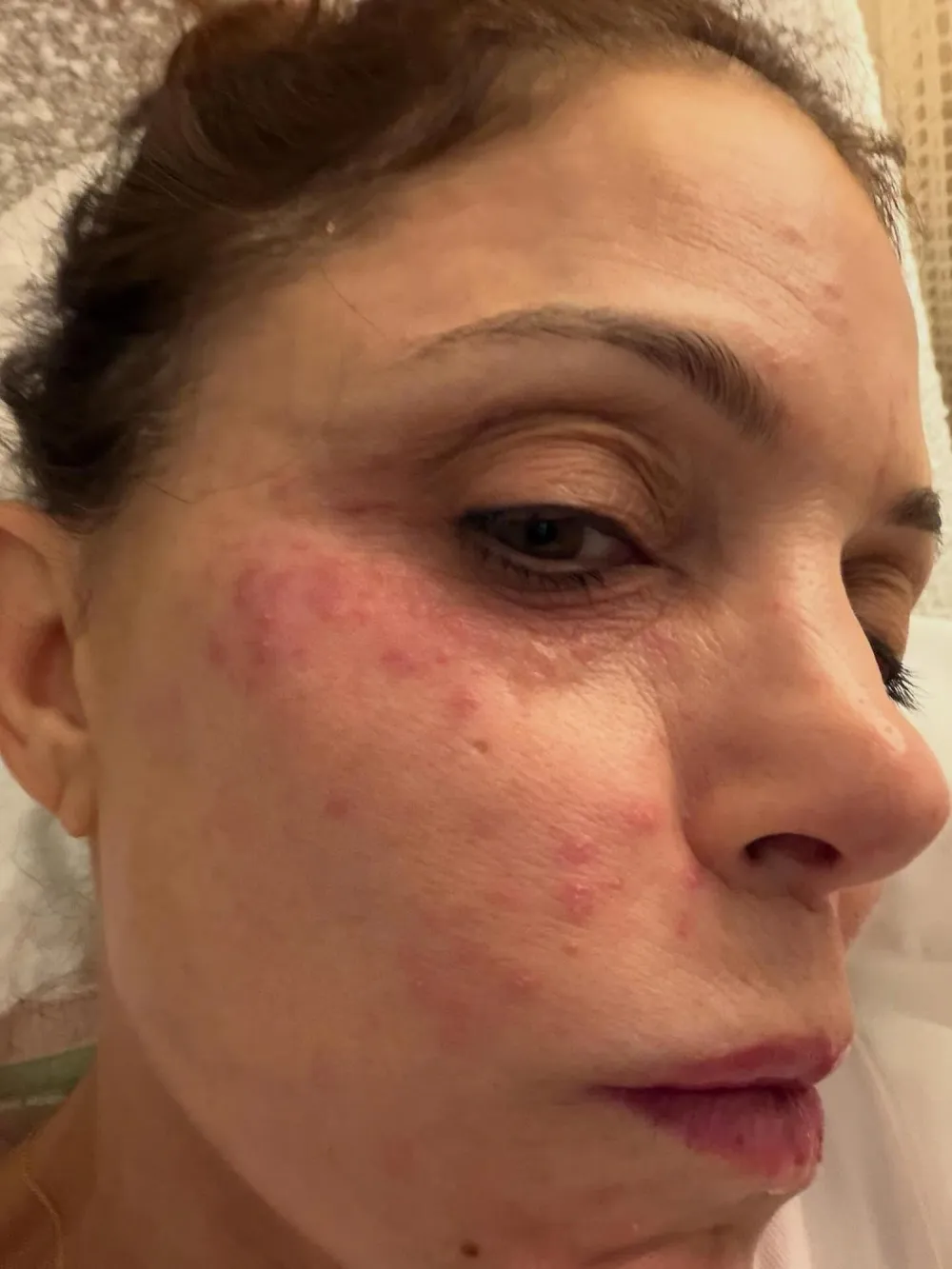 Bethenny Frankel Shows Face Covered in a Rash After Catching a Bacterial Infection in St Barts
