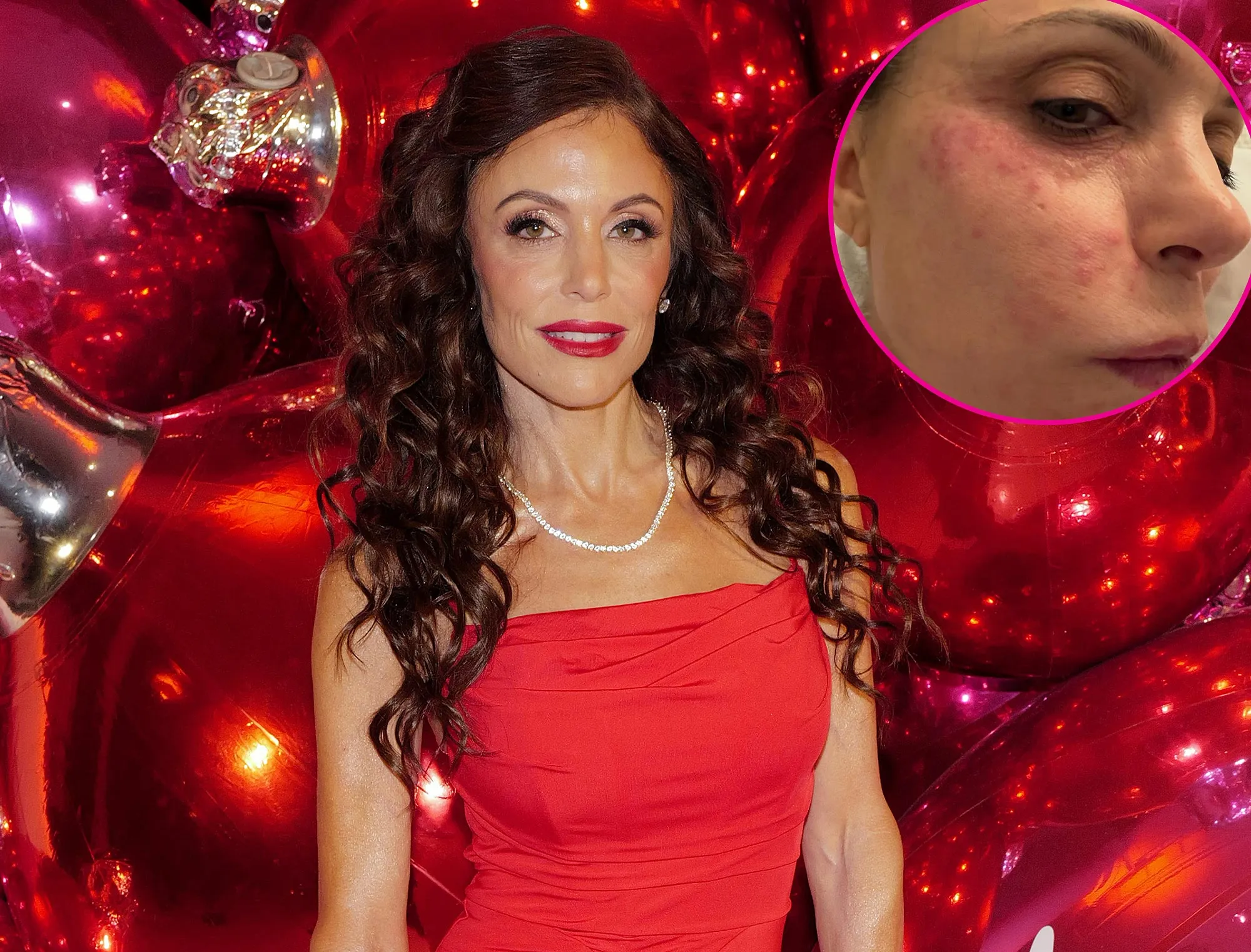 Bethenny Frankel Shows Face Covered in a Rash After Catching a Bacterial Infection in St Barts