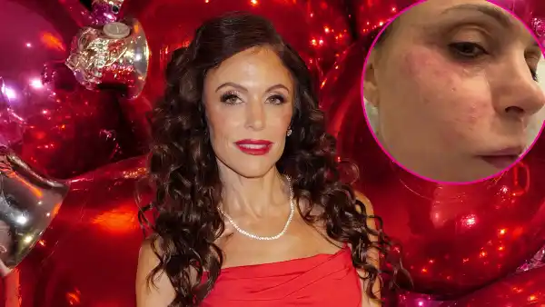 Bethenny Frankel Shows Face Covered in a Rash After Catching a Bacterial Infection in St Barts