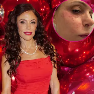 Bethenny Frankel Shows Face Covered in a Rash After Catching a Bacterial Infection in St Barts