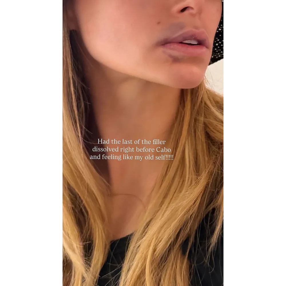 Brooks Nader Reflects on Dissolving Her Lip Filler