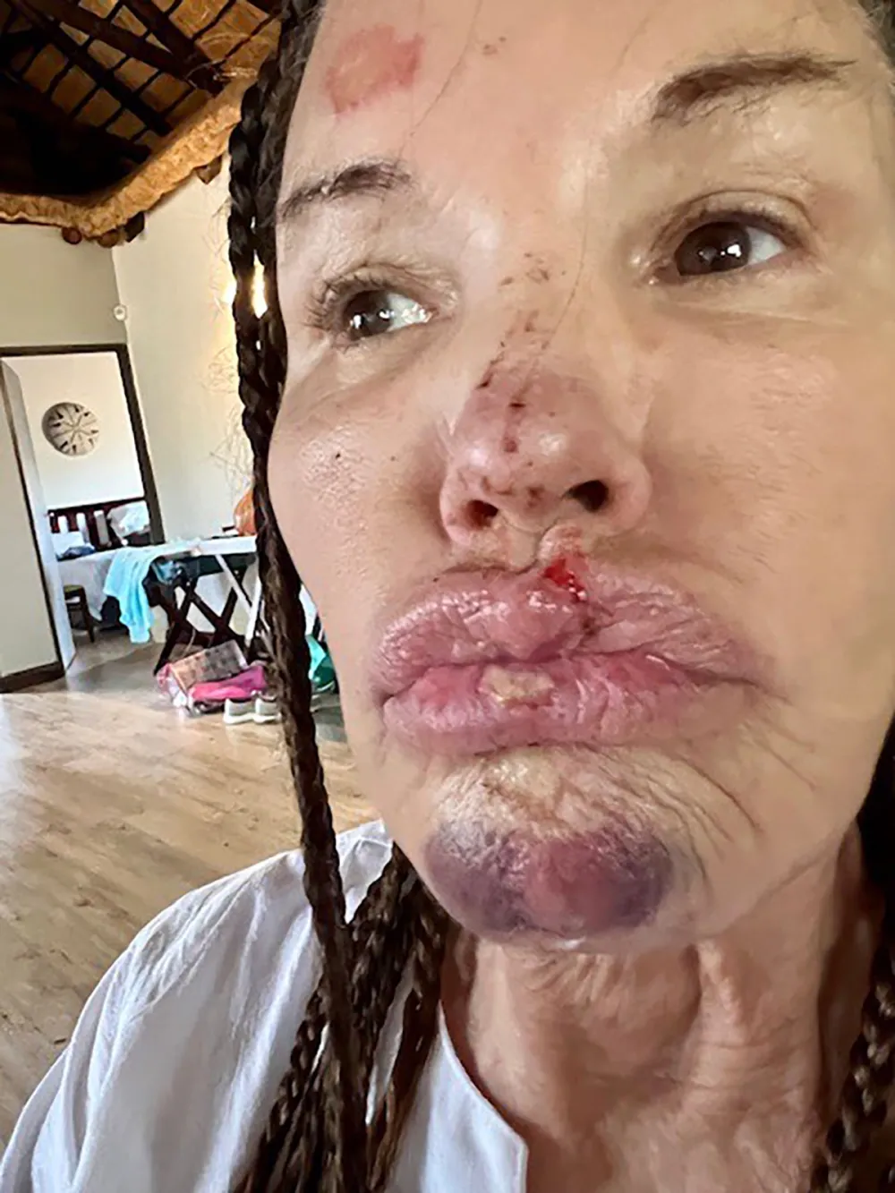Janice Dickenson Shares Photos From Brutal On Set Injury 4