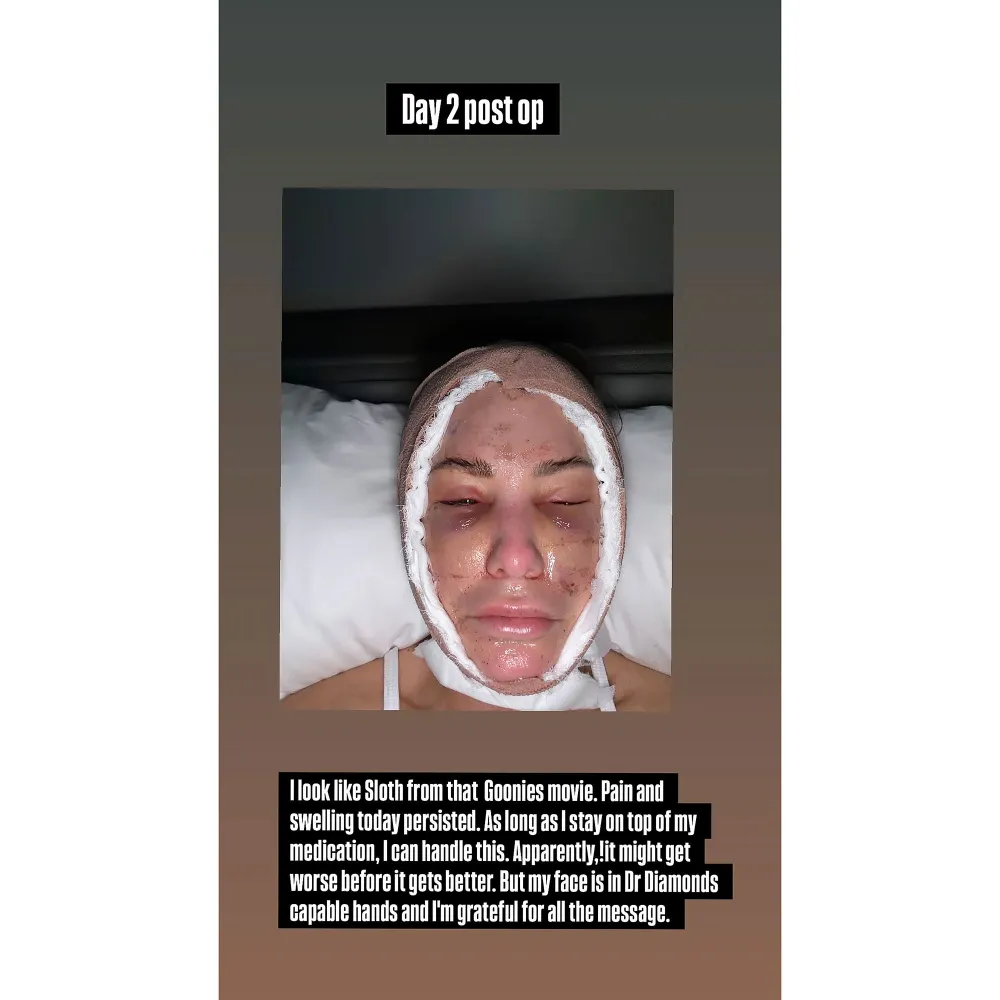 Million Dollar Listing Tracy Tutor Shows Her Bandaged and Bruised Face in a Progress Photo After Neck and Facelift