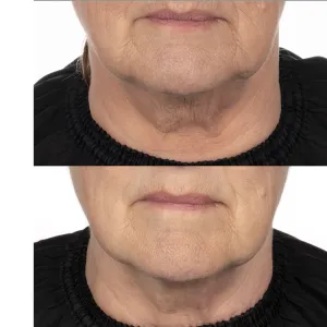 Noble Panacea Before and After