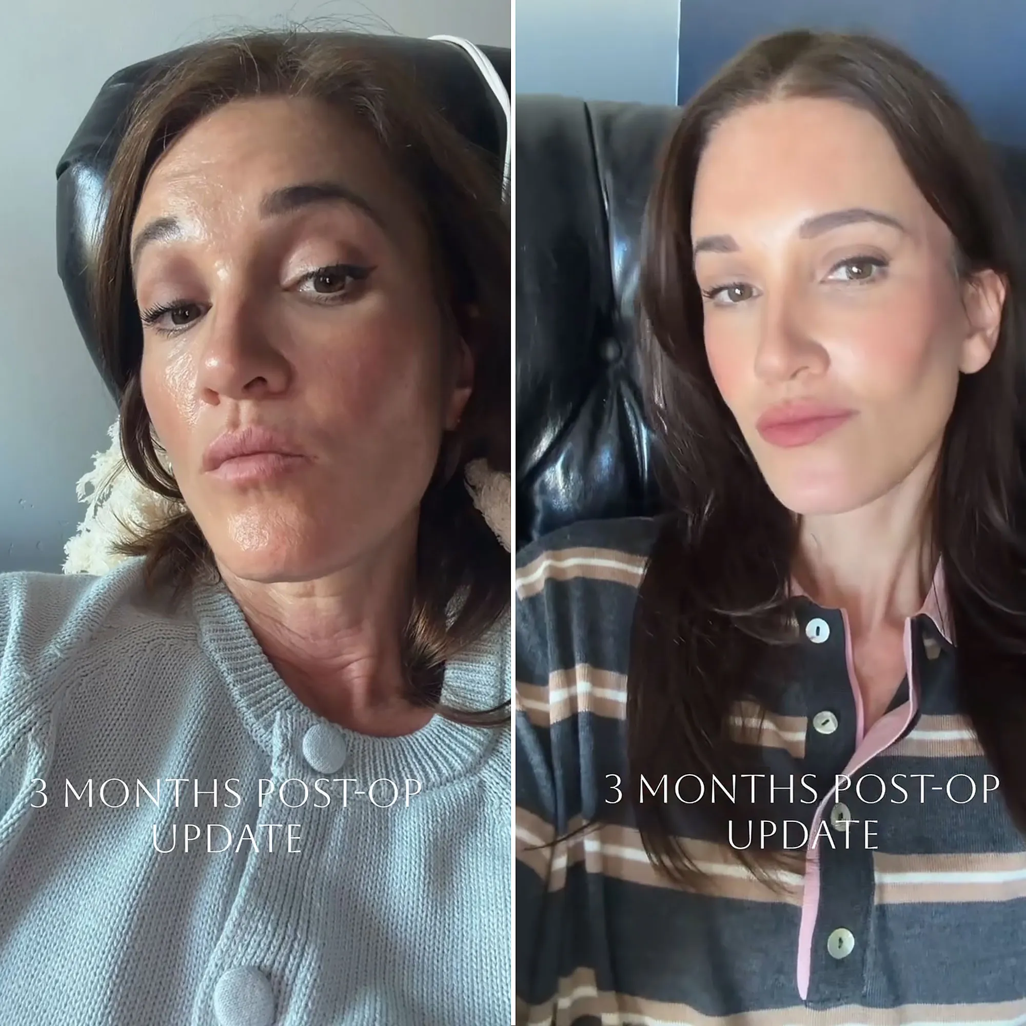 Influencer Katie Anderson Reveals the Results of Her 2nd Facelift at 48