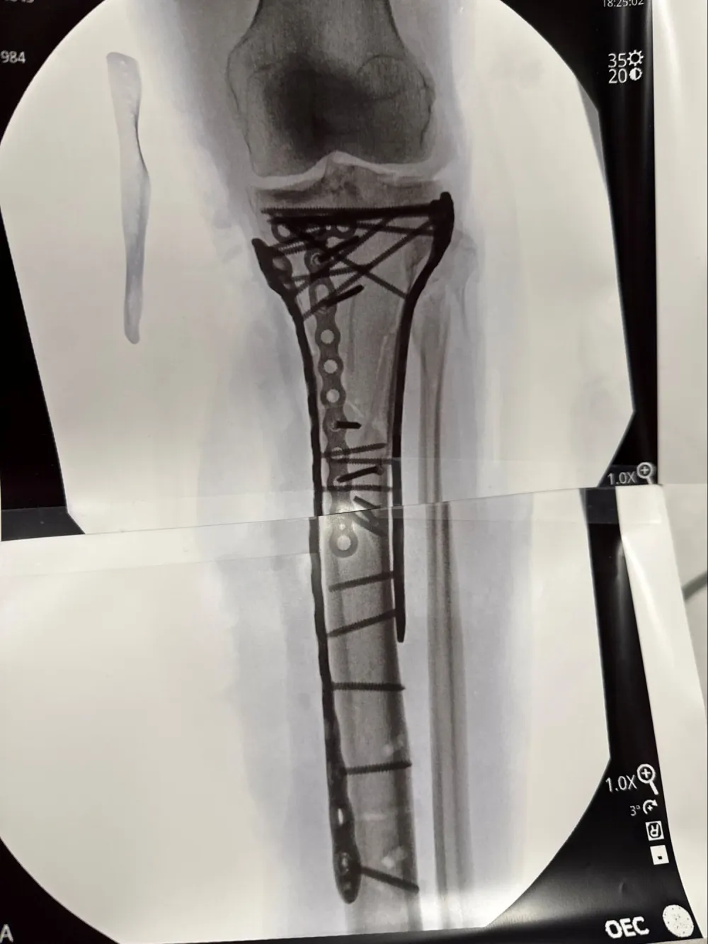 Lindsey Vonn X-Ray
