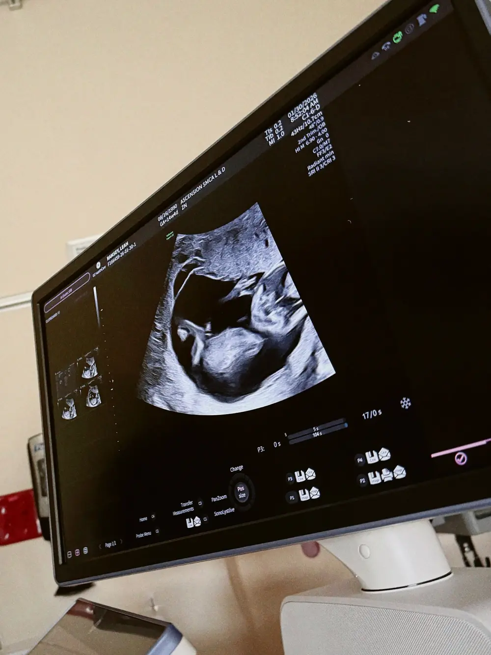 Pregnant Influencer Shares Doctors Had to Stop Her Heart for 80 Minutes During Surgery