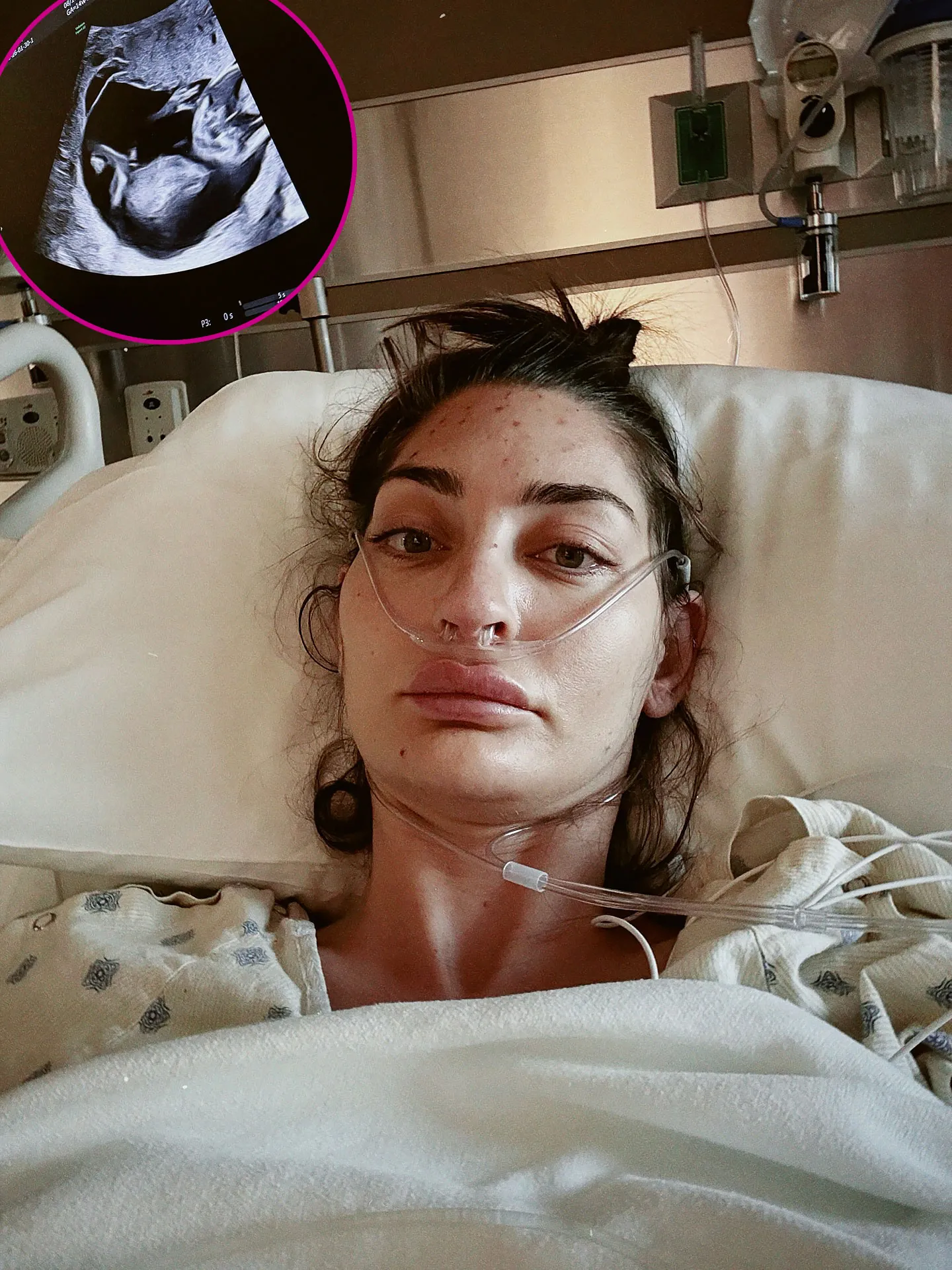 Promo Pregnant Influencer Shares Doctors Had to Stop Her Heart for 80 Minutes During Surgery
