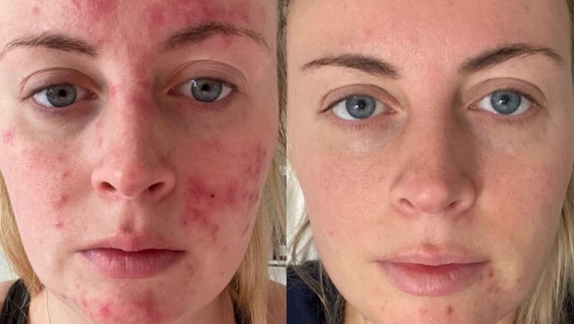 Before and After Blemish Picture