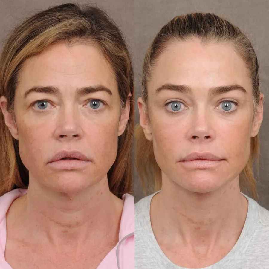 Celebrities Who Have Spoken About Plastic Surgery Denise Richards March 2026 Facelift