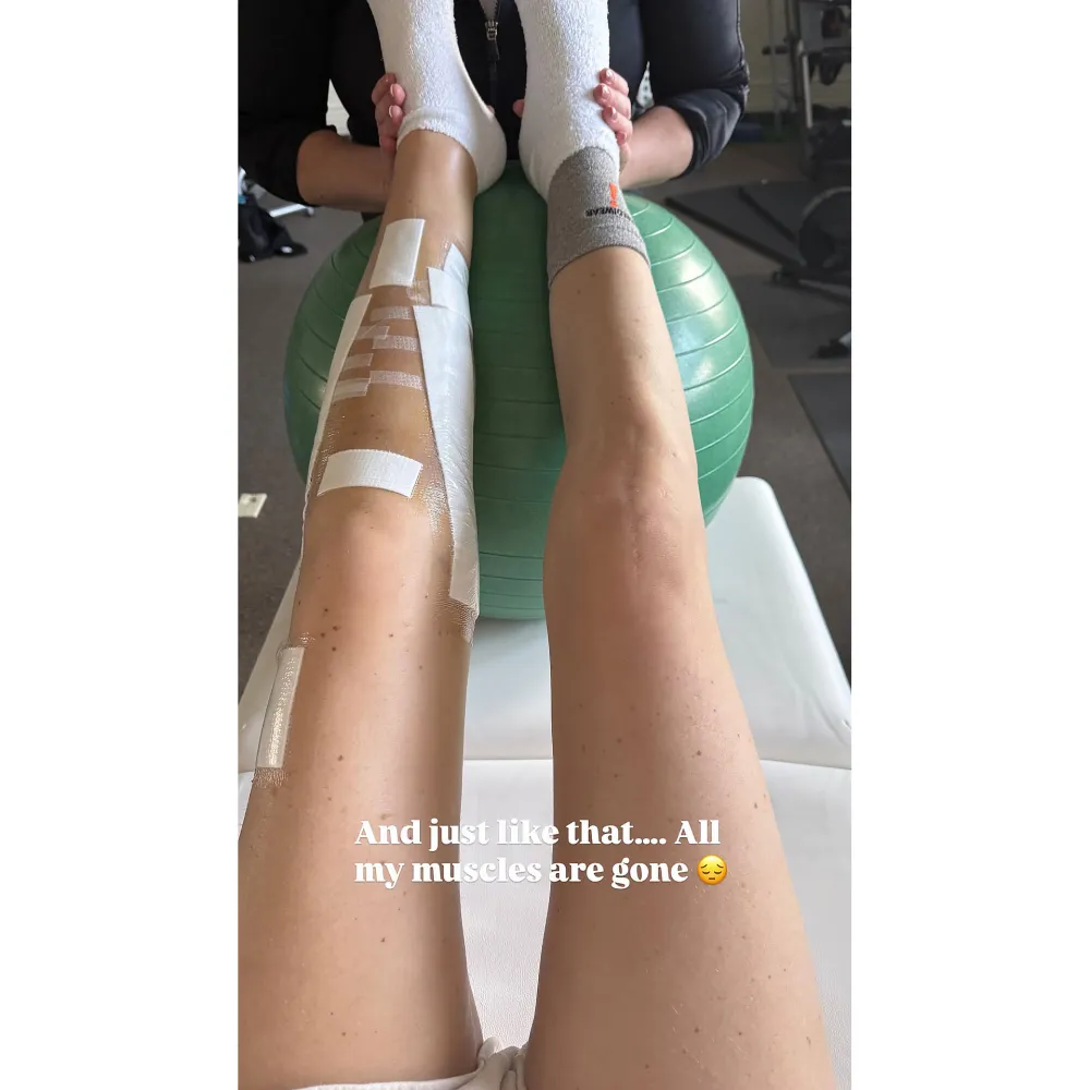 Lindsey Vonn Shares Dramatic Picture of Her Legs After Multiple Surgeries Instagram