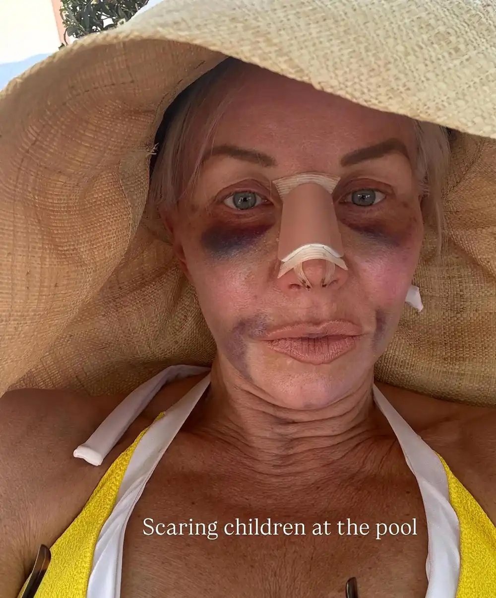 Margaret Josephs 58 Shows Off Nose Job Results After Being Bruised and Bandaged