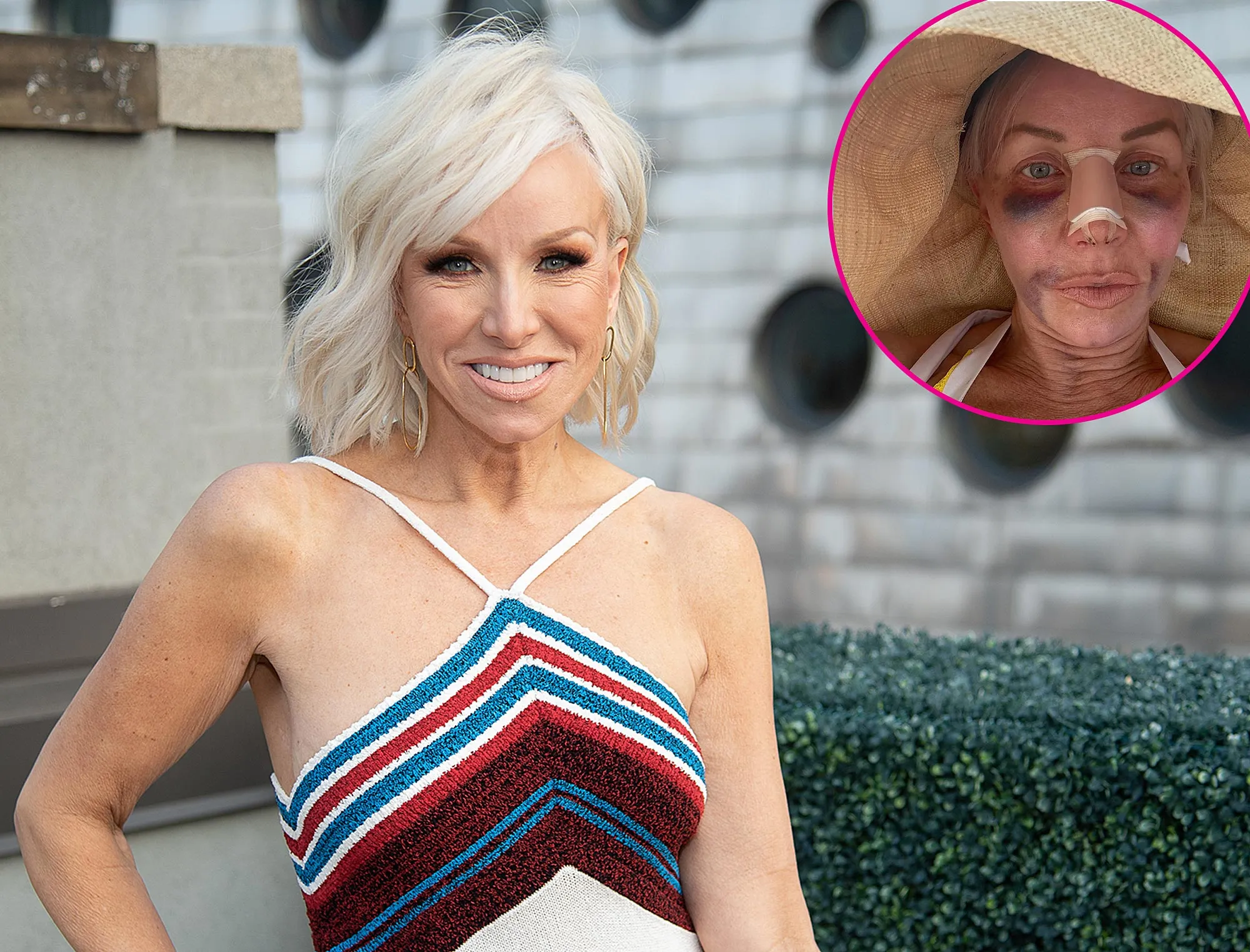 Margaret Josephs 58 Shows Off Nose Job Results After Being Bruised and Bandaged