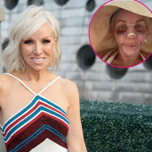 Margaret Josephs 58 Shows Off Nose Job Results After Being Bruised and Bandaged