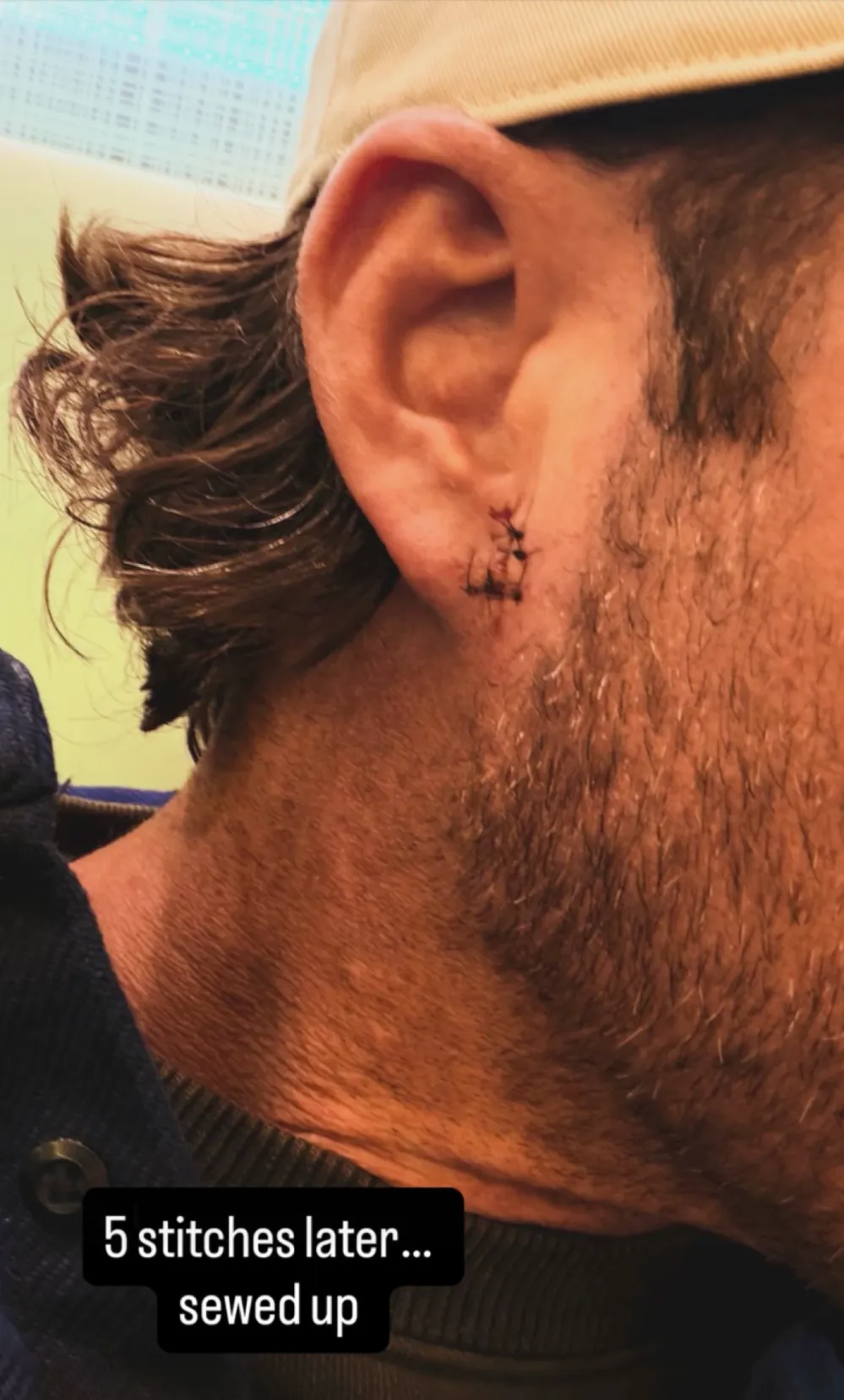 Riley Green Gets 5 Stitches After Fan Throws Phone at His Ear Him Makes Him Bleed Sewed Up