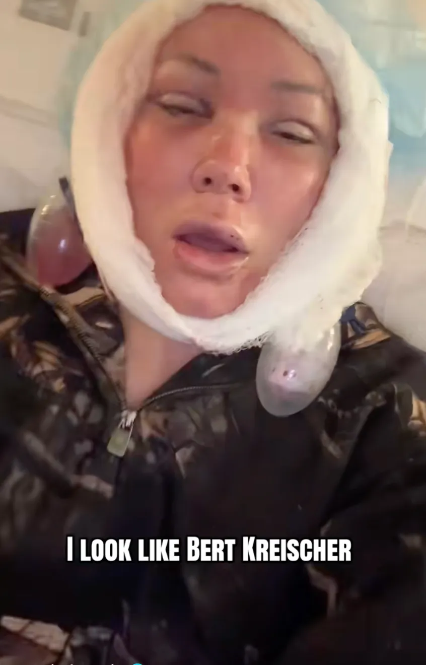 Jelly Roll's Wife Bunnie Xo Reveals Brutal Facelift Recovery