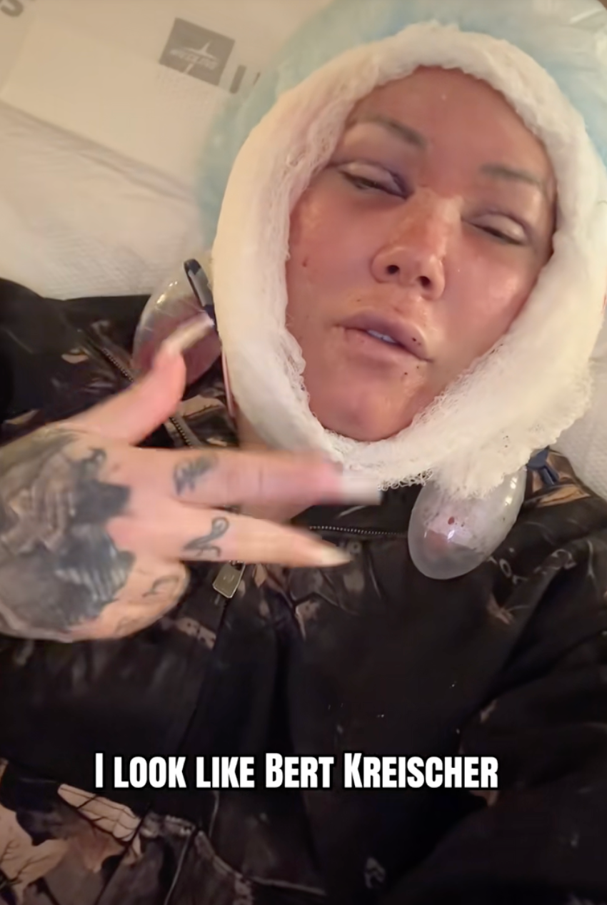 Jelly Roll's Wife Bunnie Xo Reveals Brutal Facelift Recovery